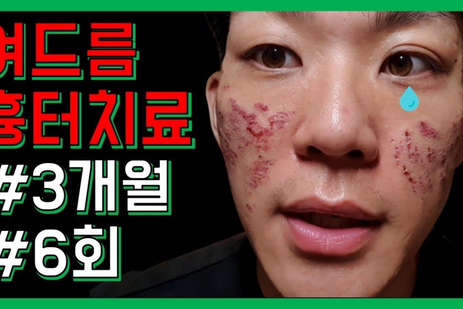 여드름 흉터치료 세달 동안 6회 시술 끝낸 후기 (Ft. 새살침 코라테라피) - Youtube