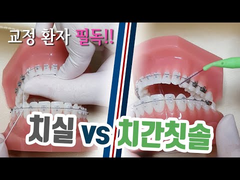 치아교정 양치질 : 치실 vs 치간칫솔 교정했을때 사용하는 방법은 다르다!! 치아교정 환자 필독!!