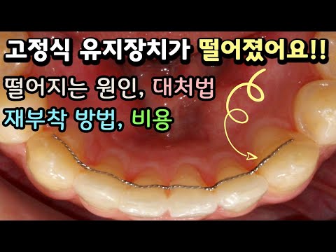 고정식 유지장치 탈락ㅣ떨어지는 원인ㅣ대처법ㅣ재부착 방법ㅣ비용ㅣ가격ㅣ남자 치과위생사의 교정일기 11편