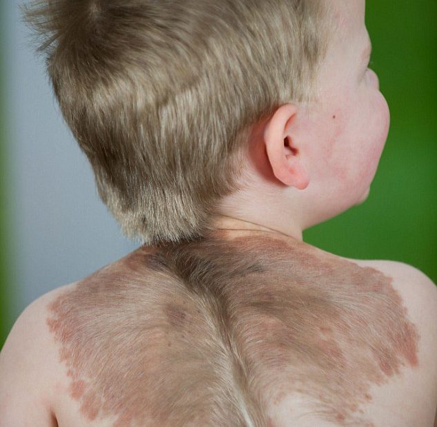 Toddler Oliver Has Rare Skin Condition That Gives Him 'Wings' | Daily Mail  Online