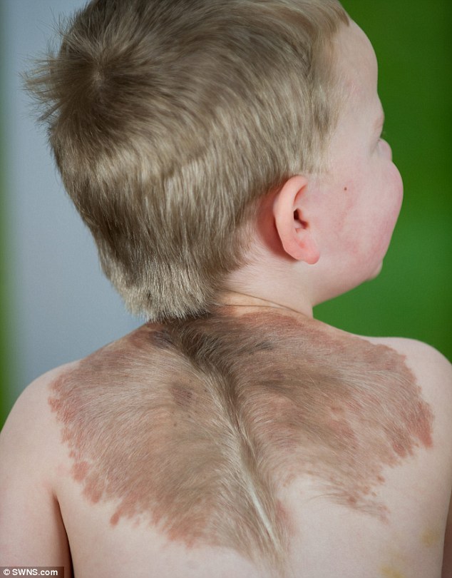 Toddler Oliver Has Rare Skin Condition That Gives Him 'Wings' | Daily Mail  Online