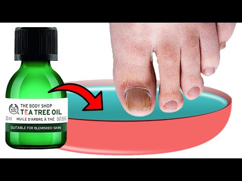 How To Get Rid of Toenail Fungus NATURALLY With TEA TREE OIL