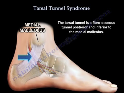 Tarsal Tunnel Syndrome, causes and treatment.